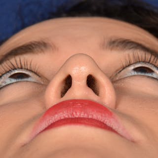 Corrective / Revision Rhinoplasty Before & After Gallery - Patient 846130 - Image 8