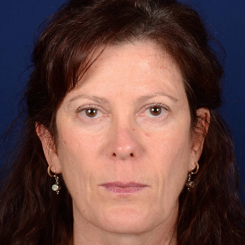 Corrective / Revision Rhinoplasty Before & After Gallery - Patient 625318 - Image 1