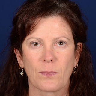 Corrective / Revision Rhinoplasty Before & After Gallery - Patient 625318 - Image 2