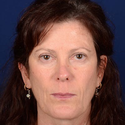 Corrective / Revision Rhinoplasty Before & After Gallery - Patient 625318 - Image 2