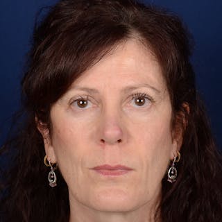 Corrective / Revision Rhinoplasty Before & After Gallery - Patient 625318 - Image 2