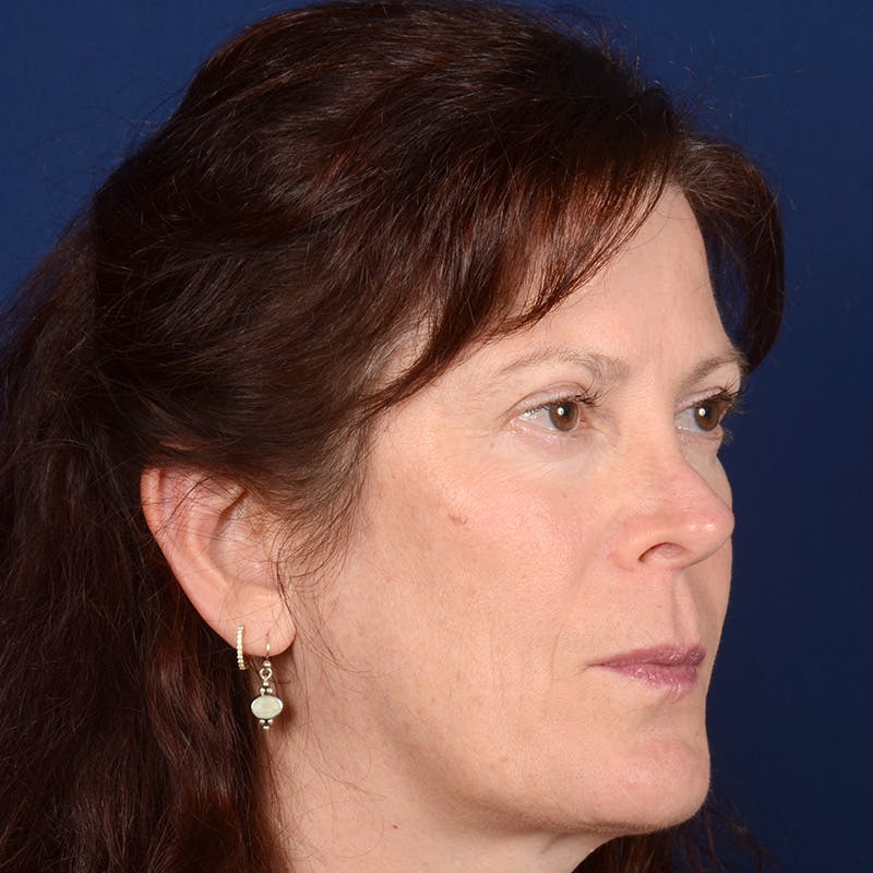 Corrective / Revision Rhinoplasty Before & After Gallery - Patient 625318 - Image 3