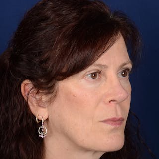 Corrective / Revision Rhinoplasty Before & After Gallery - Patient 625318 - Image 4