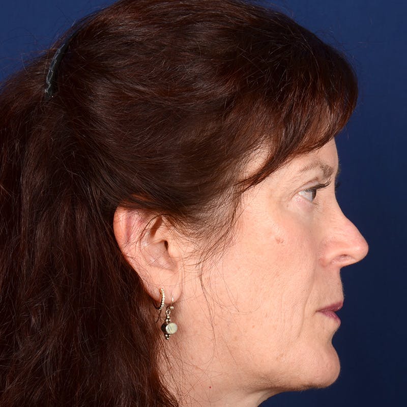 Corrective / Revision Rhinoplasty Before & After Gallery - Patient 625318 - Image 5