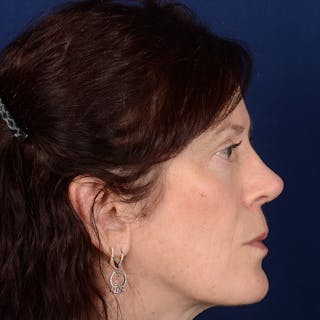 Corrective / Revision Rhinoplasty Before & After Gallery - Patient 625318 - Image 6