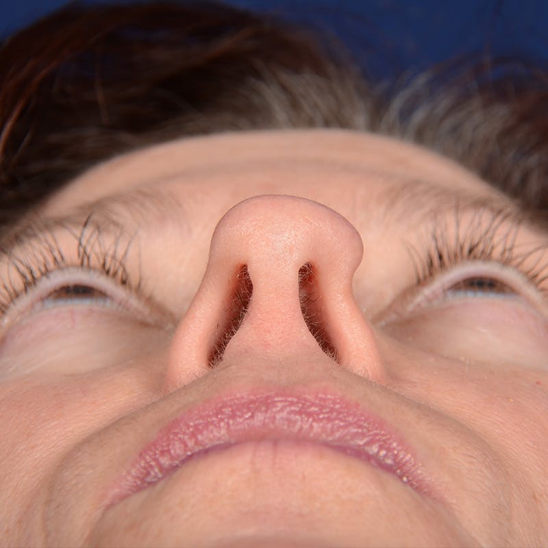 Corrective / Revision Rhinoplasty Before & After Gallery - Patient 625318 - Image 7