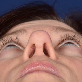Corrective / Revision Rhinoplasty Before & After Gallery - Patient 625318 - Image 8