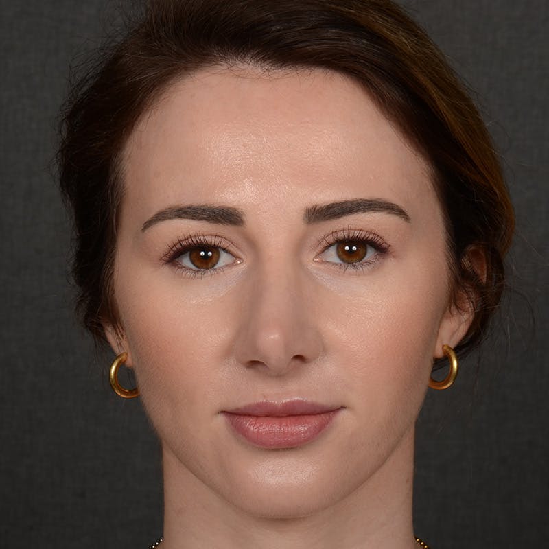 Corrective / Revision Rhinoplasty Before & After Gallery - Patient 416346 - Image 1