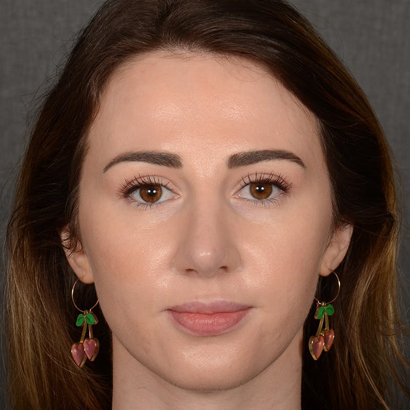 Corrective / Revision Rhinoplasty Before & After Gallery - Patient 416346 - Image 2