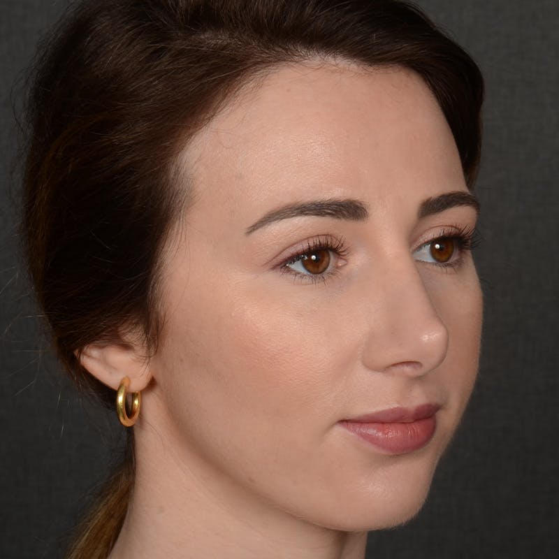 Corrective / Revision Rhinoplasty Before & After Gallery - Patient 416346 - Image 3