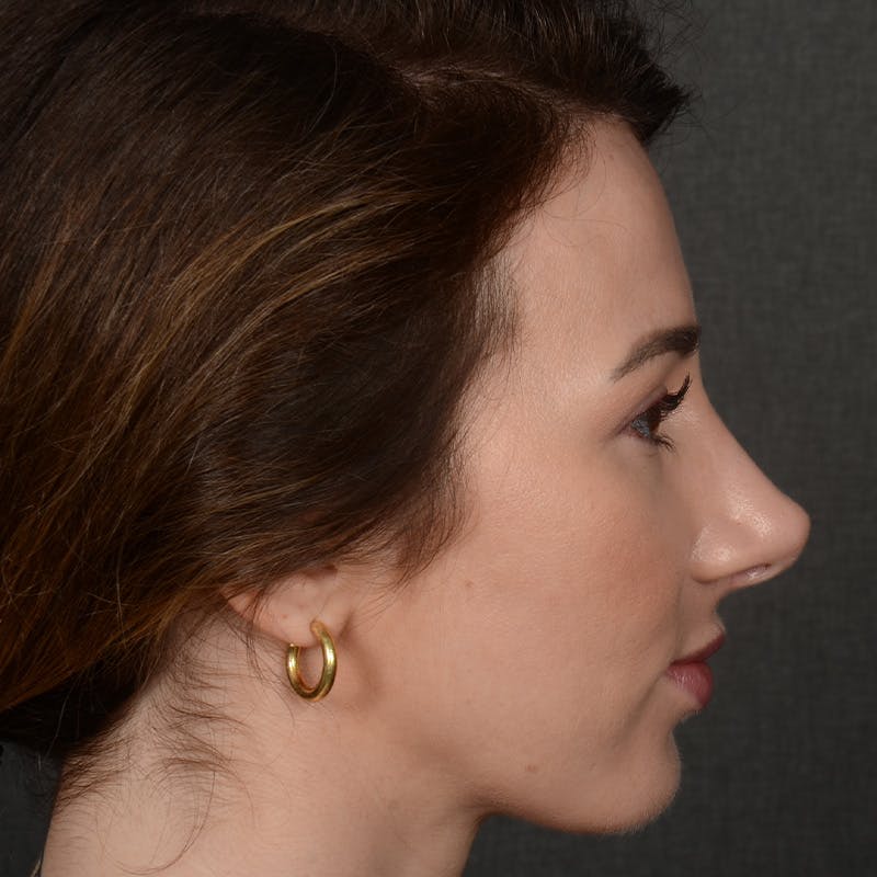 Corrective / Revision Rhinoplasty Before & After Gallery - Patient 416346 - Image 5