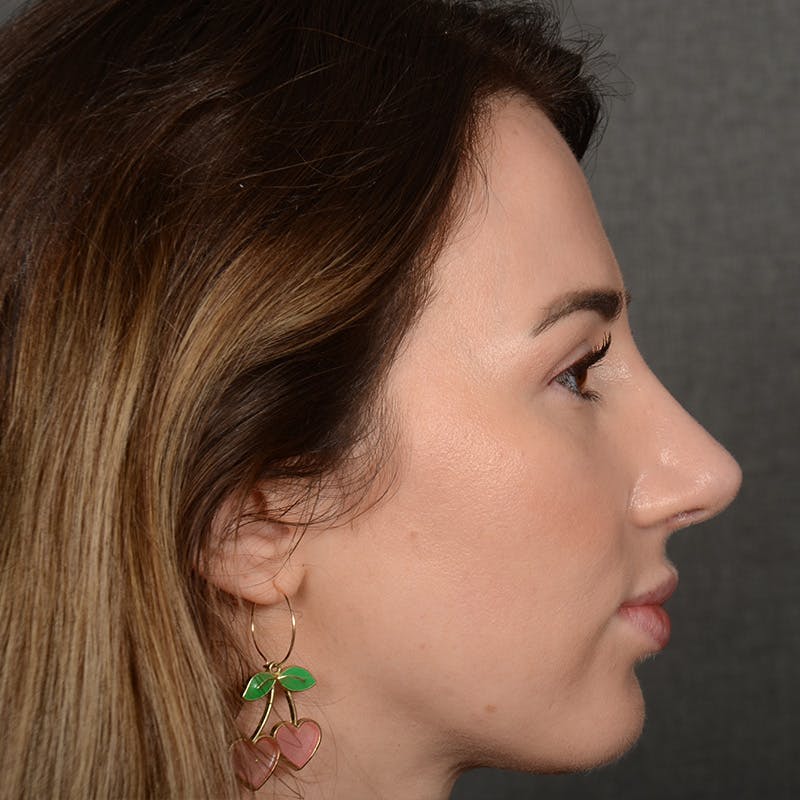 Corrective / Revision Rhinoplasty Before & After Gallery - Patient 416346 - Image 6