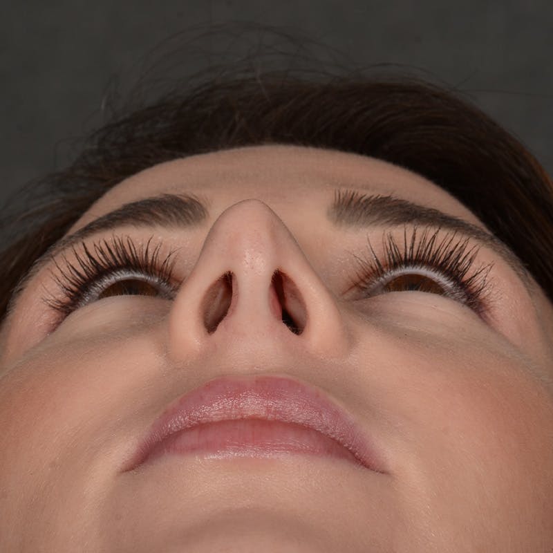 Corrective / Revision Rhinoplasty Before & After Gallery - Patient 416346 - Image 7