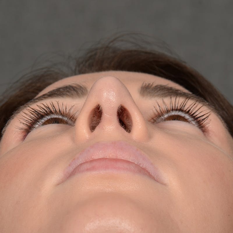 Corrective / Revision Rhinoplasty Before & After Gallery - Patient 416346 - Image 8