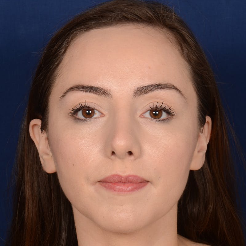 Corrective / Revision Rhinoplasty Before & After Gallery - Patient 110847 - Image 1