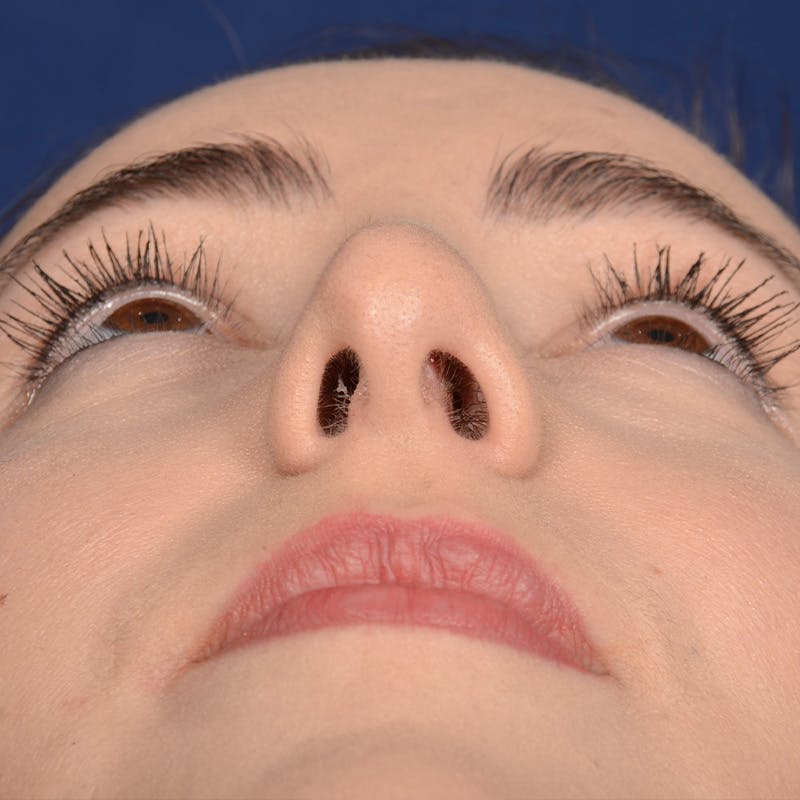 Corrective / Revision Rhinoplasty Before & After Gallery - Patient 110847 - Image 3