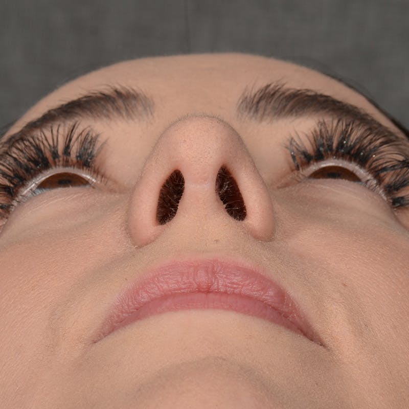 Corrective / Revision Rhinoplasty Before & After Gallery - Patient 110847 - Image 4