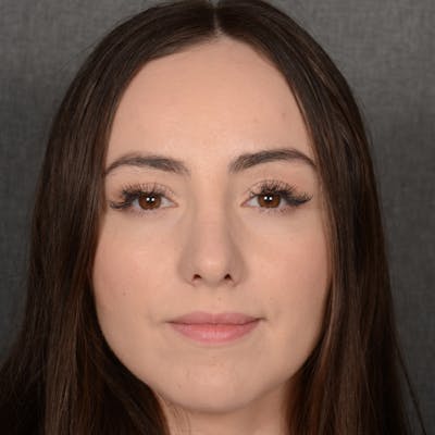 Corrective / Revision Rhinoplasty Before & After Gallery - Patient 110847 - Image 2