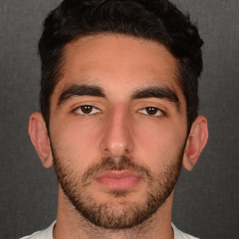 Male Rhinoplasty Before & After Gallery - Patient 294002 - Image 1