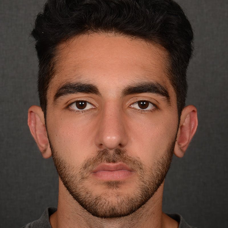 Male Rhinoplasty Before & After Gallery - Patient 294002 - Image 2