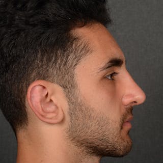 Male Rhinoplasty Before & After Gallery - Patient 294002 - Image 6