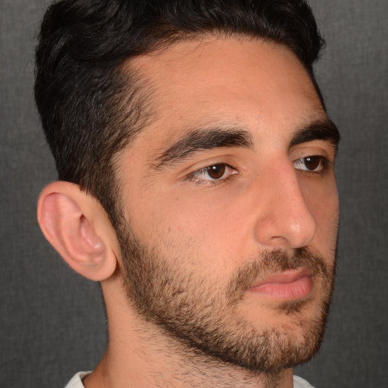Male Rhinoplasty Before & After Gallery - Patient 294002 - Image 3
