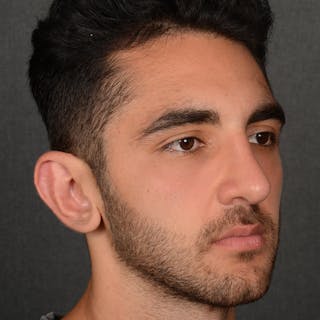 Male Rhinoplasty Before & After Gallery - Patient 294002 - Image 4