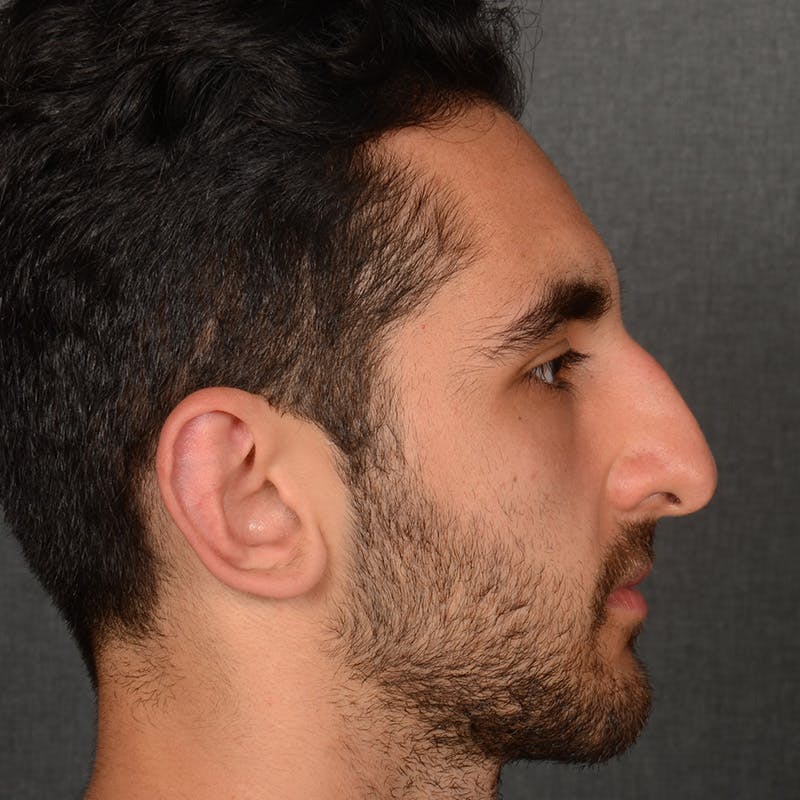 Male Rhinoplasty Before & After Gallery - Patient 294002 - Image 5