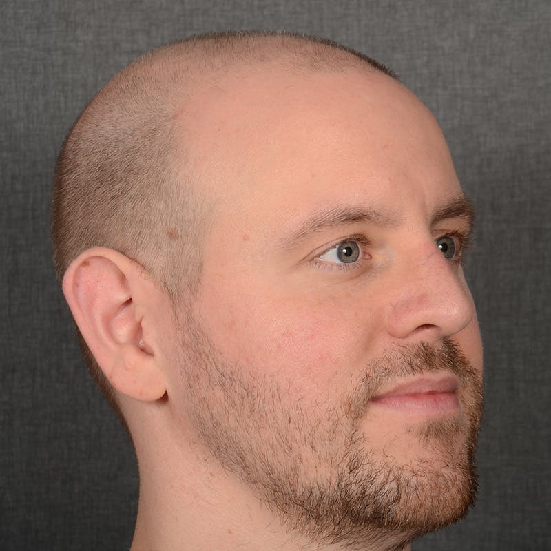 Male Rhinoplasty Before & After Gallery - Patient 594551 - Image 4
