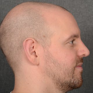 Male Rhinoplasty Before & After Gallery - Patient 594551 - Image 6