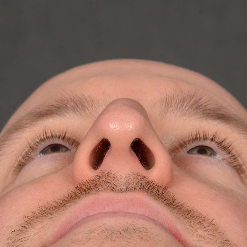 Male Rhinoplasty Before & After Gallery - Patient 594551 - Image 7