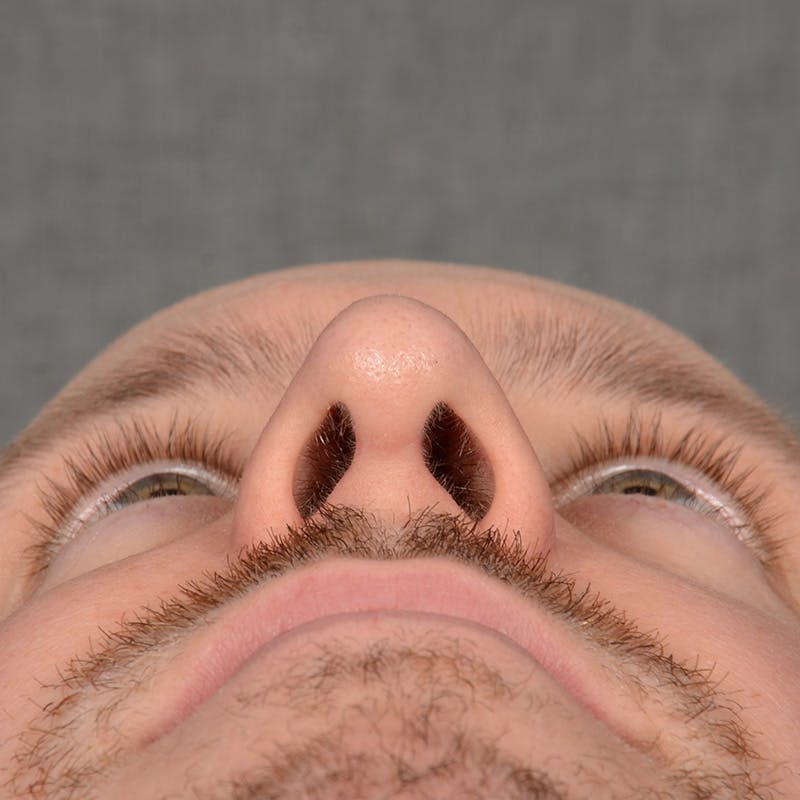 Male Rhinoplasty Before & After Gallery - Patient 594551 - Image 8