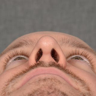 Male Rhinoplasty Before & After Gallery - Patient 594551 - Image 8