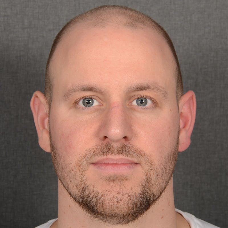 Male Rhinoplasty Before & After Gallery - Patient 594551 - Image 2