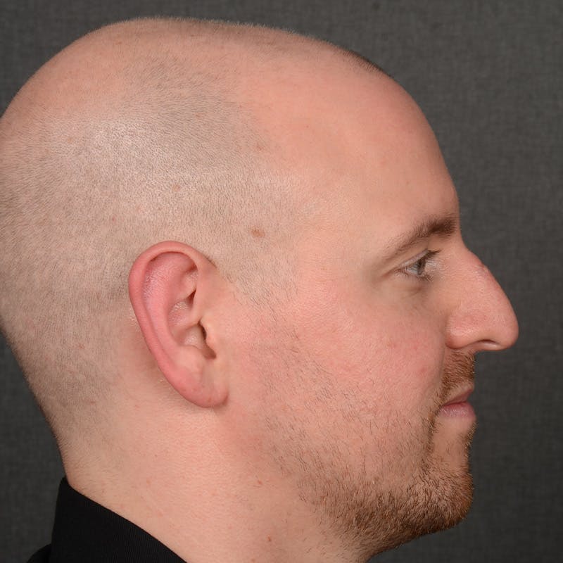 Male Rhinoplasty Before & After Gallery - Patient 594551 - Image 5