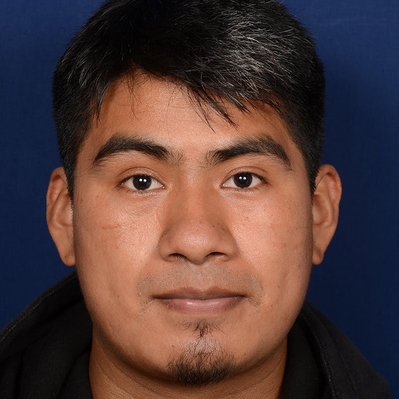 Male Rhinoplasty Before & After Gallery - Patient 393961 - Image 1