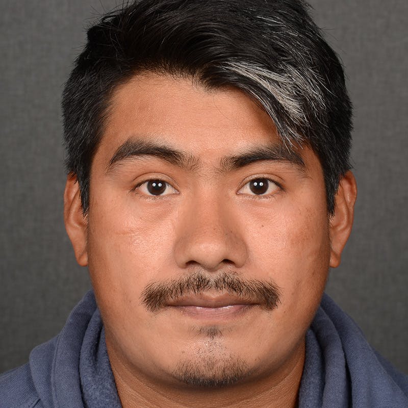 Male Rhinoplasty Before & After Gallery - Patient 393961 - Image 2