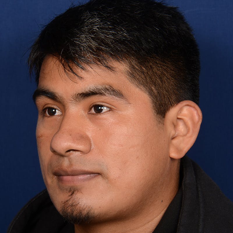 Male Rhinoplasty Before & After Gallery - Patient 393961 - Image 3