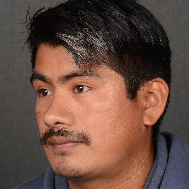 Male Rhinoplasty Before & After Gallery - Patient 393961 - Image 4
