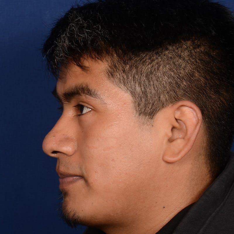Male Rhinoplasty Before & After Gallery - Patient 393961 - Image 5