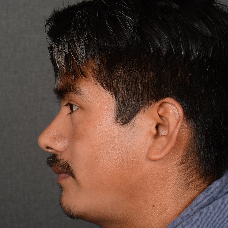 Male Rhinoplasty Before & After Gallery - Patient 393961 - Image 6