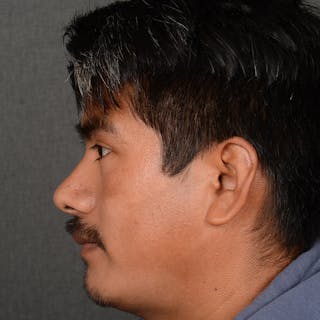 Male Rhinoplasty Before & After Gallery - Patient 393961 - Image 6