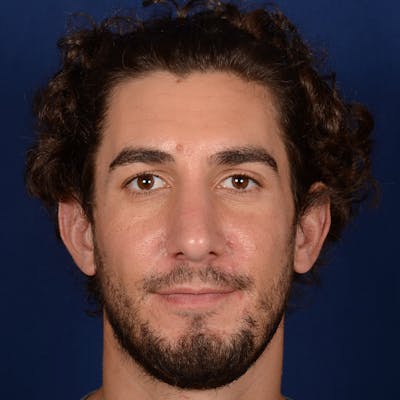 Male Rhinoplasty Before & After Gallery - Patient 210420 - Image 2