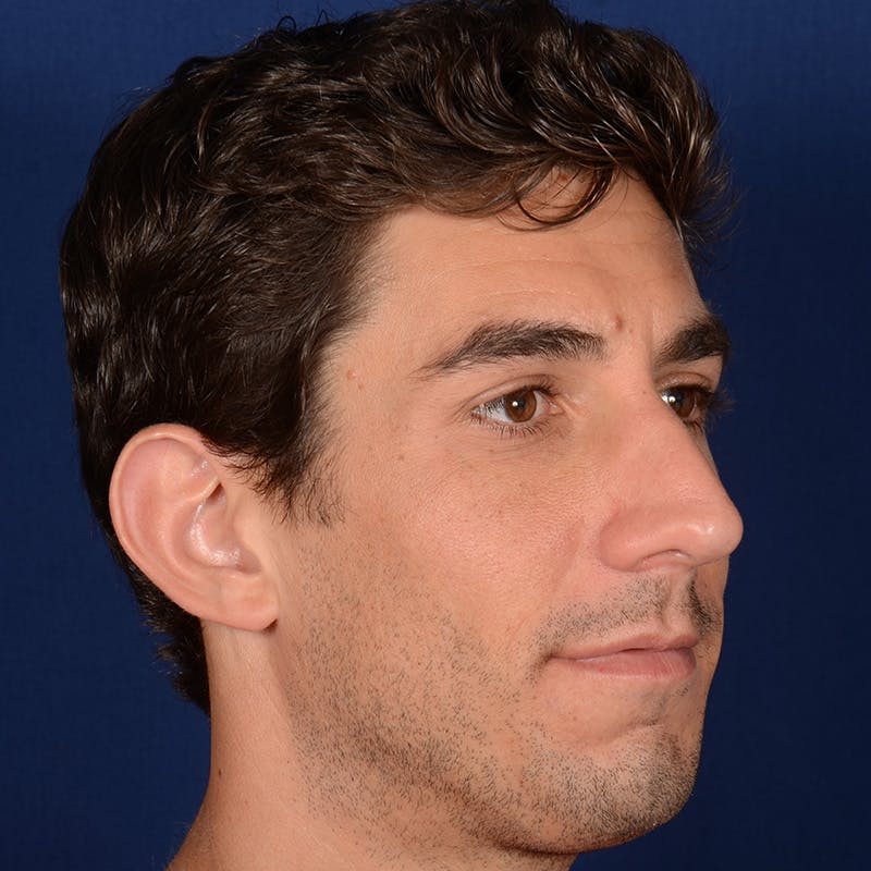 Male Rhinoplasty Before & After Gallery - Patient 210420 - Image 3