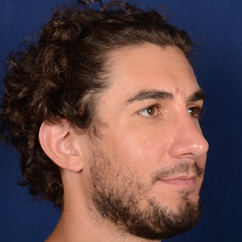 Male Rhinoplasty Before & After Gallery - Patient 210420 - Image 4