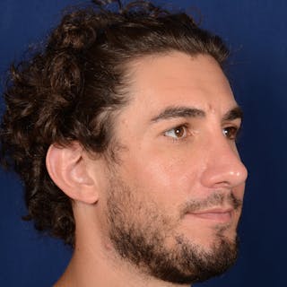 Male Rhinoplasty Before & After Gallery - Patient 210420 - Image 4