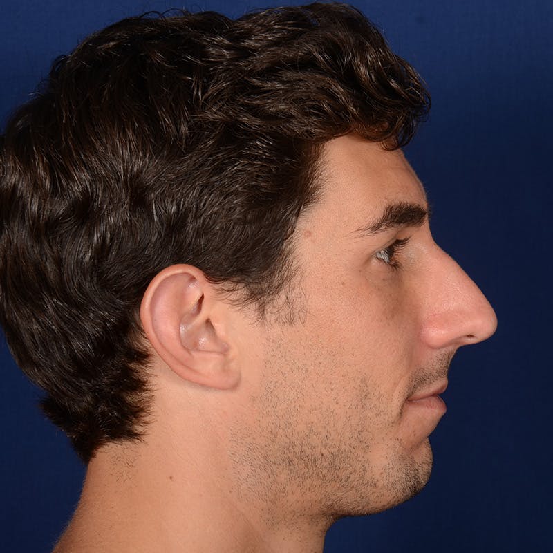 Male Rhinoplasty Before & After Gallery - Patient 210420 - Image 5