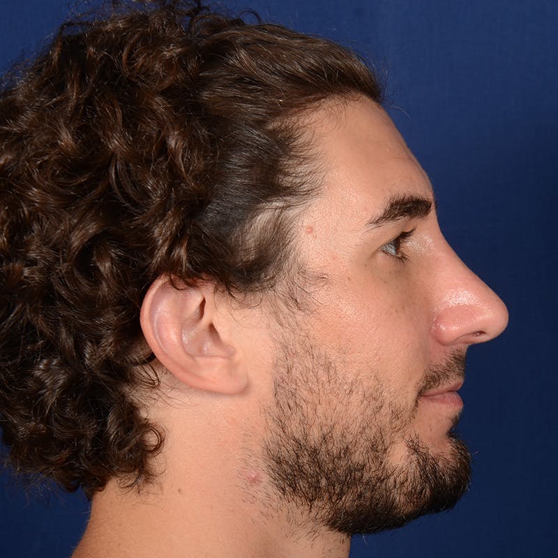 Male Rhinoplasty Before & After Gallery - Patient 210420 - Image 6
