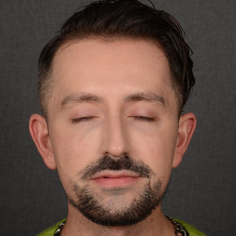 Male Rhinoplasty Before & After Gallery - Patient 343166 - Image 1