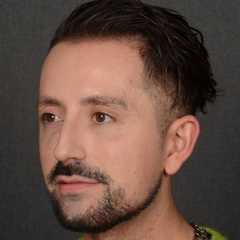 Male Rhinoplasty Before & After Gallery - Patient 343166 - Image 3